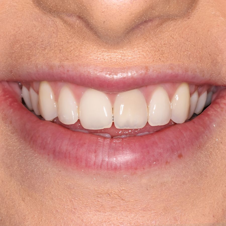 composite veeners before - 3dental